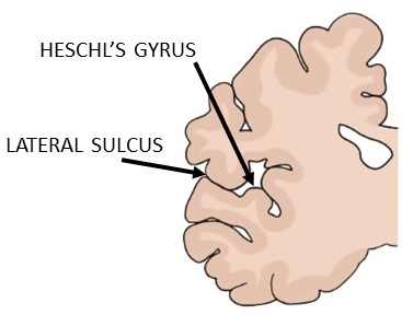 Heschl s gyrus